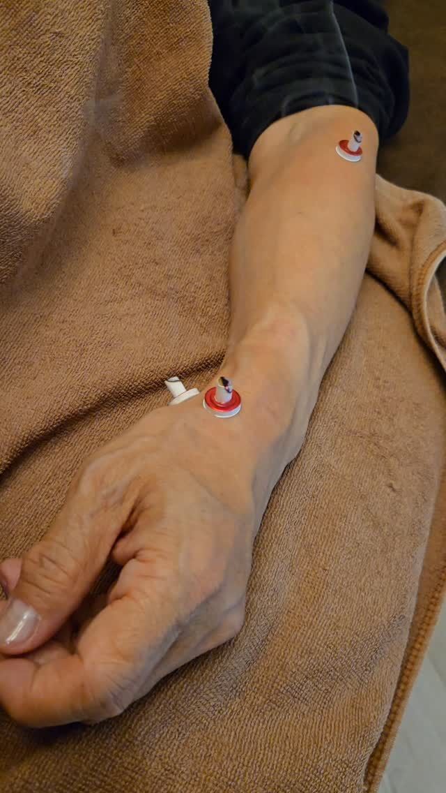 実はこのお灸、なんと「3年間」も手首の痛みに悩まされている患者様への施術なんです🔥

​手首や腕のガンコな痛みって、日々の生活でも使う場所だから本当にツラいですよね😢

​長引く痛みの裏には、気づかないうちに蓄積された筋肉の「冷え」や「ガチガチの緊張」が隠れていることが多いんです。

​そこで活躍するのがお灸のパワー！

ジワ〜っと体の芯まで温熱を届けることで、固まった筋肉をゆるゆるにほぐし、痛みの元をスッキリ流していきます✨

​「お灸って熱そう…」というイメージがあるかもしれませんが、心地よいんですよ🤤

​八千代市で「長引く手首の痛み」や「どこに行っても変わらない不調」にお悩みの方。

「もう治らないかも…」と諦める前に、いぬかい鍼灸指圧院にご相談ください🙌

​毎日頑張っているあなたの体、そろそろしっかり労ってあげませんか？☺️

ご予約はプロフィールのリンクからお待ちしております！

​📍いぬかい鍼灸指圧院（八千代市）

#八千代市
#お灸
#手首の痛み
#長引く不調
#拡散